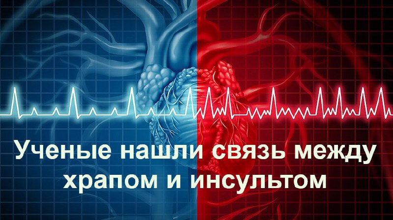 Апноэ сна повышает риск инсульта: исследование Стэнфорда