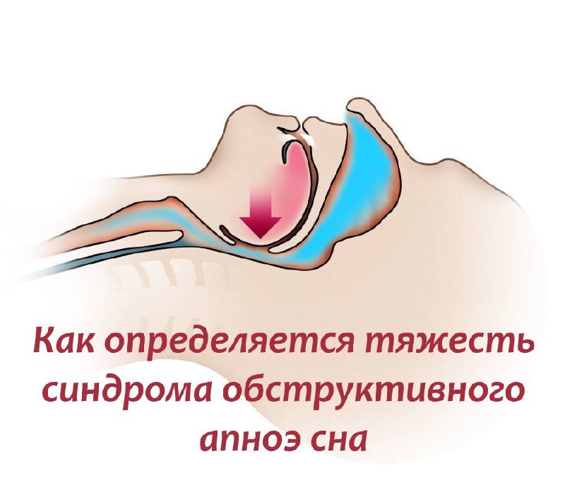 Как ставят диагноз апноэ сна: от жалоб до ночного исследования